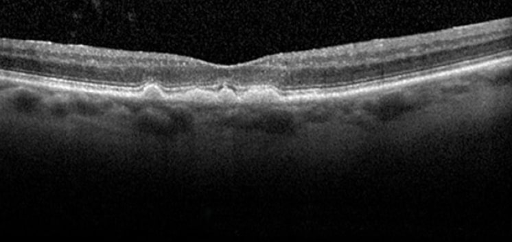 Clinical images of dry age-related macular degeneration