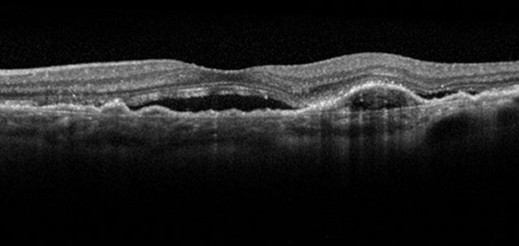 Clinical images of wet age-related macular degeneration